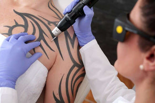 Is Tattoo Removal Dangerous