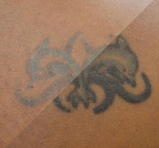 Before and After laser Tattoo Removal