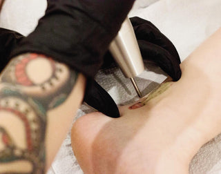 Laser Tattoo Removal Healing