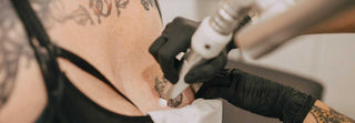 Ways to Remove Your Unwanted Tattoo