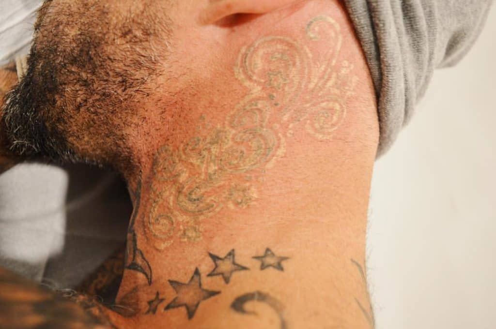Remove New Tattoo / New laser technology makes tattoo removal faster : Removal of a new tattoo new tattoos are not easier to remove than old tattoos.